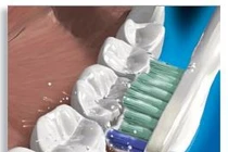 Lười vệ sinh răng miệng dễ bị ung thư