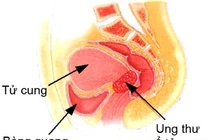 Tác dụng phụ xạ trị và hoá trị?