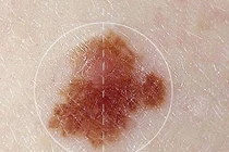 Hy vọng mới cho những người ung thư da