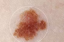 Hy vọng mới cho những người ung thư da