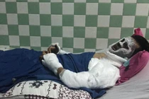 Việt kiều bị tạt axit, cắt gân chân: Mặt hỏng 90%, mắt có thể bị mù