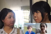 2 cô gái bị chồng đổ xăng đốt biến dạng hình hài