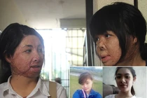 2 cô gái bị chồng đổ xăng đốt biến dạng hình hài