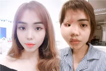 Dung nhan cô gái bị cựu thiếu úy công an tạt axit hủy hoại thế nào?