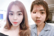 Dung nhan cô gái bị cựu thiếu úy công an tạt axit hủy hoại thế nào?