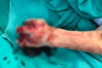 Dùng iphone trong khi sạc, bệnh nhi phải cắt cụt tay 