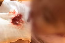 Viêm tuỵ cấp ở trẻ em như bệnh nhi 11 tuổi nguy hiểm thế nào?