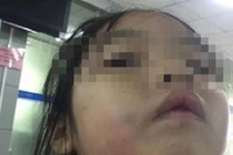 Cô giáo dùng thước đánh vào mặt bé gái 5 tuổi suốt 8 phút