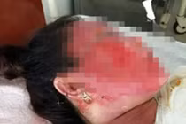 Chồng đổ nước sôi lên người vợ vì đi chơi về muộn mà không khóa cửa