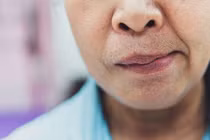 Liệt mặt, méo miệng sau khi ngủ phòng điều hòa, phòng tránh thế nào?