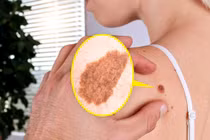 Nốt ruồi xuất hiện và khi nào cần đến bác sĩ để kiểm tra?