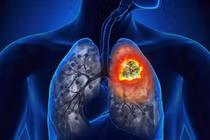 Dấu hiệu cảnh báo sớm 7 bệnh ung thư nguy hiểm bạn cần nhớ