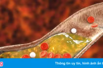 Người gầy có bị máu nhiễm mỡ?