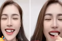 Quế Vân rụng răng sứ trông "dở khóc dở cười"