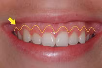 Cười hở lợi là sướng hay khổ, có ảnh hưởng đến tình duyên?