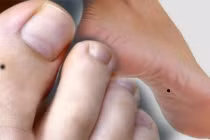 3 nốt ruồi ở chân mang may mắn, có 1 cũng sướng cả đời