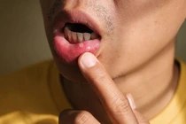 Phương pháp xử lý nhanh nhiệt miệng