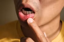 Phương pháp xử lý nhanh nhiệt miệng