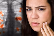 Dấu hiệu lộ trên mặt của ung thư phổi nhưng ít người biết