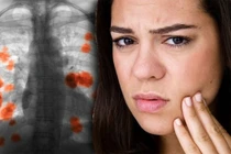 Dấu hiệu lộ trên mặt của ung thư phổi nhưng ít người biết