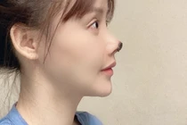 Đình chỉ công tác bác sĩ khiến nữ diễn viên hoại tử mũi ở Trung Quốc