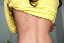 Top 8 dấu hiệu cảnh báo bạn đang bị stress nặng 