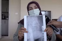 Bụng sưng đau sau phẫu thuật, bà mẹ 7 con tái mặt biết lý do