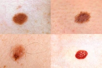 Nốt ruồi mọc ở 4 bộ phận này cần để ý kỹ