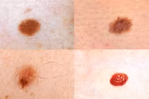 Nốt ruồi mọc ở 4 bộ phận này cần để ý kỹ