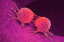 Nhiều người nhầm căn bệnh ung thư này với viêm họng 