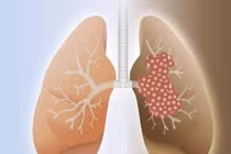 Trong giai đoạn đầu của ung thư phổi, tín hiệu này có thể xuất hiện