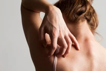 Cách phân biệt bệnh thủy đậu và bệnh sởi, chớ nhầm lẫn