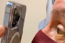 Bác sĩ dùng chiếc iPhone 13 Pro để khám mắt cho bệnh nhân