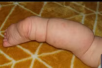 Bé gái có đôi chân bất thường, bác sĩ nghi ngờ nụ hôn lở miệng 