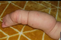 Bé gái có đôi chân bất thường, bác sĩ nghi ngờ nụ hôn lở miệng 