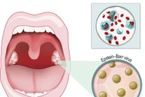 Một số bệnh do virus lây truyền qua nụ hôn