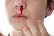 Chảy máu mũi do thói quen nhiều người hay làm, dấu hiệu bệnh hiểm