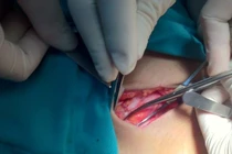 Căn bệnh phổ biến ở bé trai, nguy cơ ảnh hưởng sinh lý