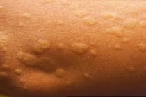 Sốc phản vệ khi ăn sá sùng: Lời cảnh báo đừng chủ quan