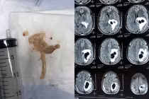 Phát hoảng bị sán làm tổ trong não vì mê món khoái khẩu 