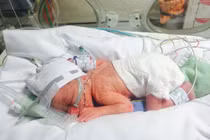 Mổ bắt thai 28 tuần: Hốt hoảng không thấy thai nhi và cái kết sững người 