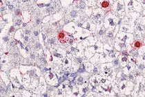 Phát hiện virus mới gây bệnh viêm gan ở người