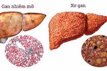 Thói quen xấu nhiều người mắc, đang bức tử lá gan của mình