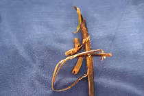 Lấy cành cây khô dài 10cm trong bàng quang bệnh nhân nam