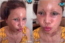 Hậu phẫu thuật thẩm mỹ, diện mạo cô dâu 62 tuổi giờ ra sao?