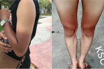 Ám ảnh mùa hè: Giữ da 3 năm ra đường cháy nắng 1 giờ