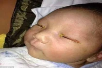 Một em bé bị mù mắt vì đèn flash máy ảnh