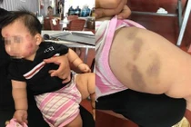 Bà mẹ tố nhà trường bạo hành trẻ em, dân mạng gay gắt lên tiếng