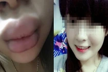 Dùng phải son rởm, cô gái Việt bị sưng môi thê thảm