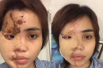 Cô gái bị thiếu uý CA tạt axit nói gì về tin “bắt cá 2 tay”?